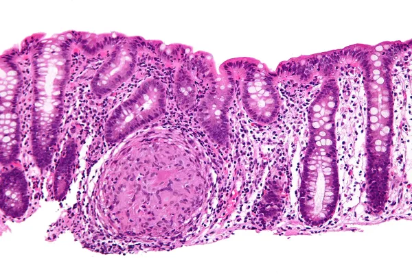 Rat Model Reproduces Key Features of Crohn's Creeping Fat