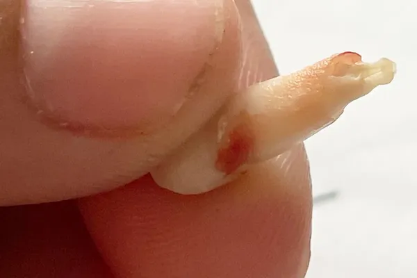 Pediatric Dental Crisis Deepens Across U.S.